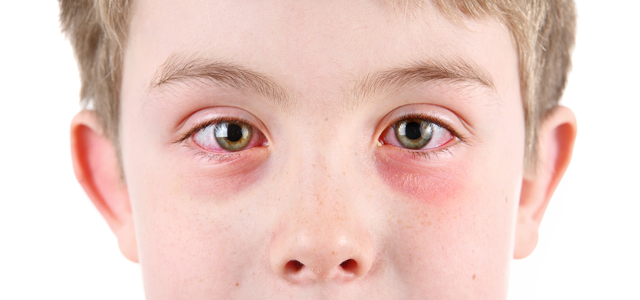 Boy with conjunctivitis